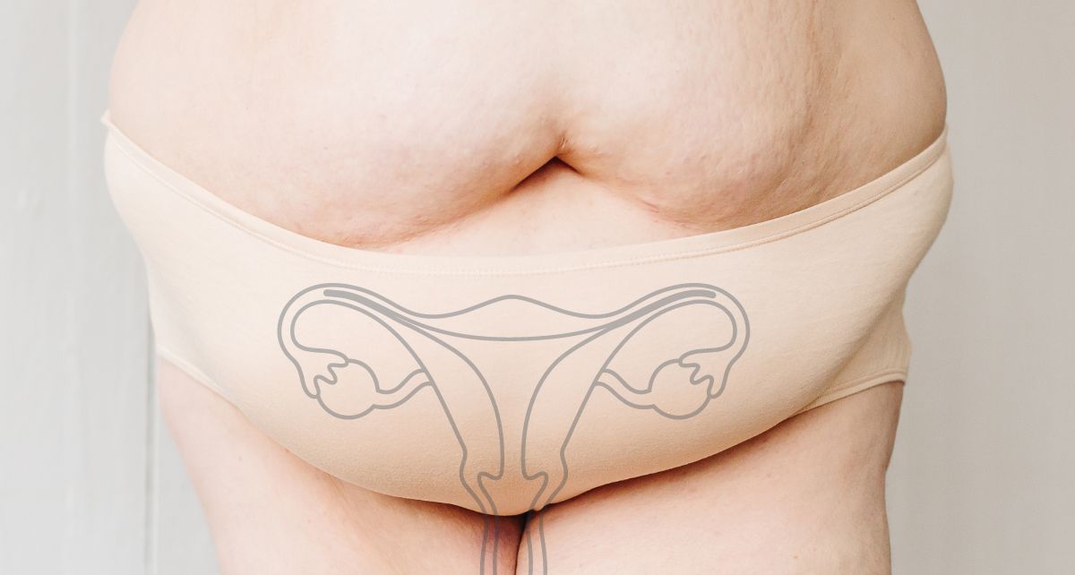 What is PCOS? Polycystic Ovarian Syndrome 101